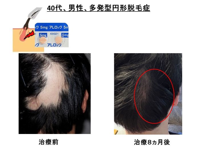 円形脱毛症　病院